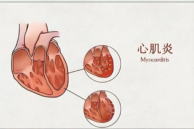 心肌炎的症状有哪些？心肌炎的主要变现症状有啥？